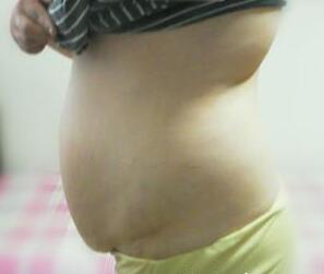 腰腹部吸脂手術(shù)