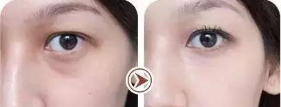 年輕人的脂肪型眼袋