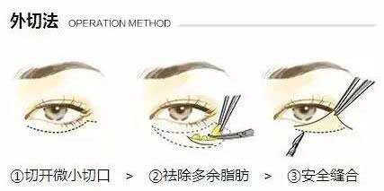 外切法祛眼袋