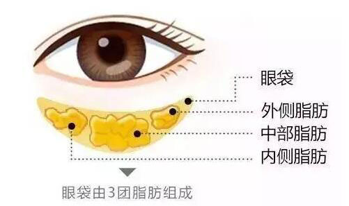 眼袋成因