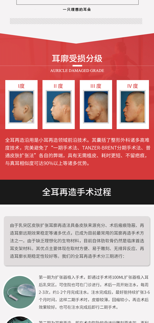 自體肋軟骨造耳術，告別耳朵缺陷——武漢同濟醫(yī)學院
