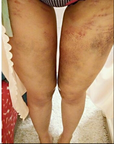 大腿吸脂手術(shù) 讓我回到了20歲自己的樣子