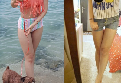大腿吸脂手術(shù) 讓我回到了20歲自己的樣子