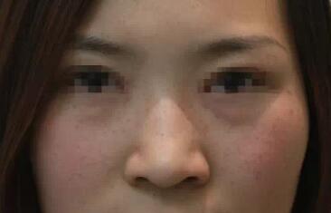 激光祛雀斑 整個(gè)人都變得清爽了