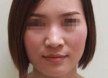 激光祛雀斑 整個(gè)人都變得清爽了