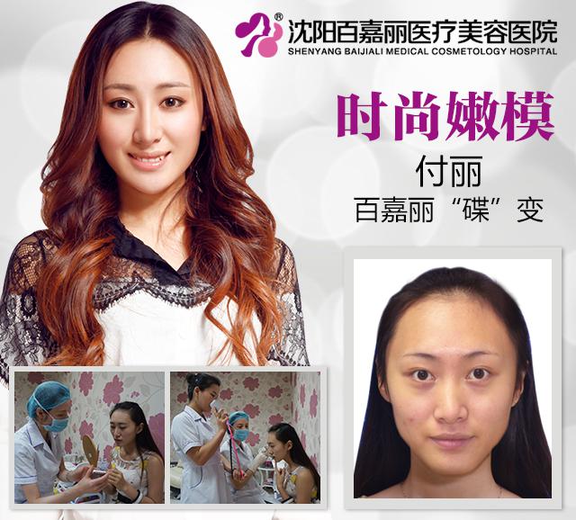 百嘉麗真人案例：付麗
