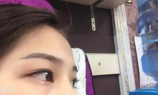 切開雙眼皮+開眼角 瞬間變大眼了