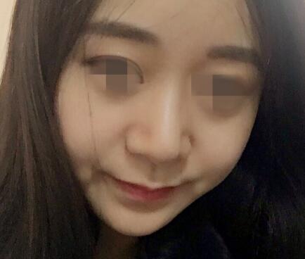 注射隆鼻
