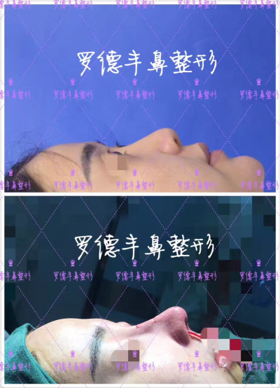 不用化妝都能塑造的美鼻 隆鼻手術(shù)很不錯(cuò)