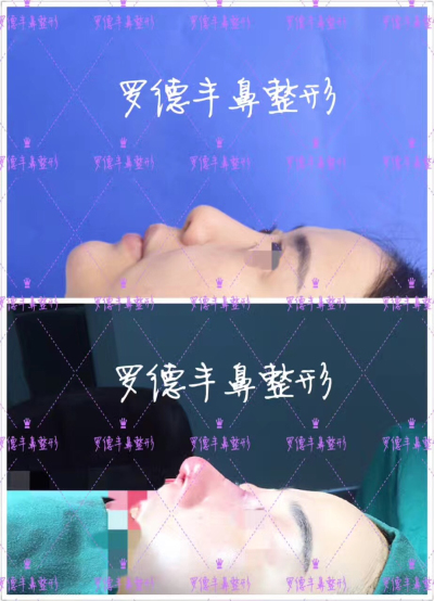 不用化妝都能塑造的美鼻 隆鼻手術(shù)很不錯(cuò)