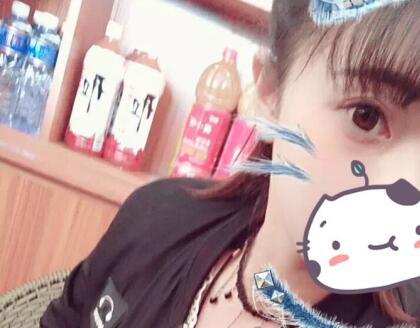 雙眼皮+開眼角術(shù)后效果