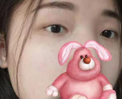 埋線雙眼皮+開眼角后  出門回頭率都高了