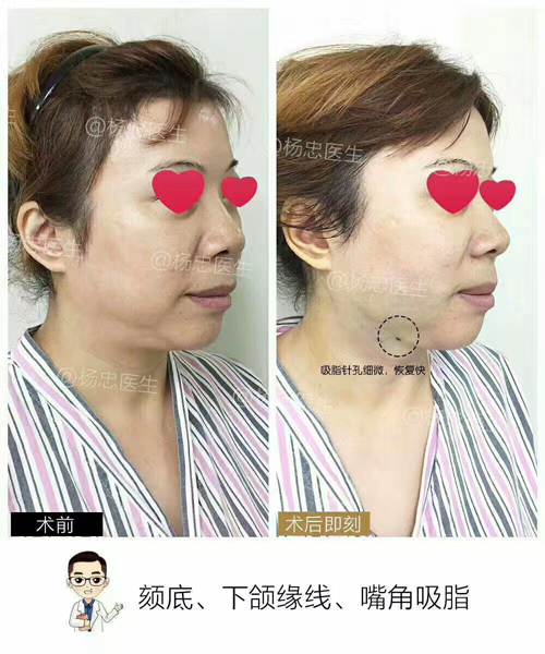 面部吸脂