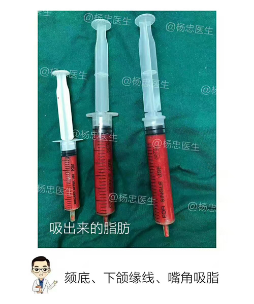 面部吸脂