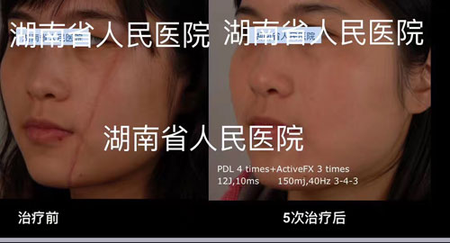 疤痕微創(chuàng)美容手術