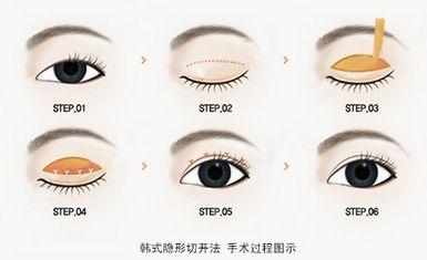雙眼皮手術(shù)