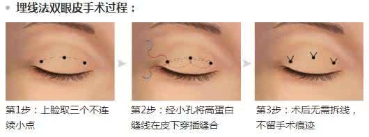 埋線雙眼皮
