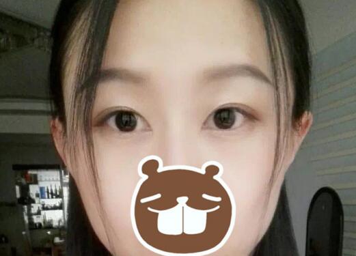 自戀下 分享下我做的雙眼皮