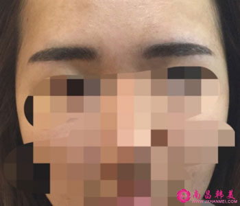 紋眉術后