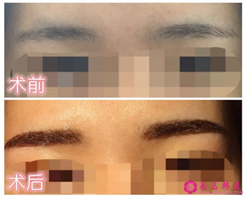 術前術后對比照