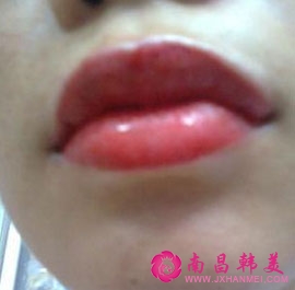 紋唇術后