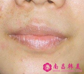 紋唇術前