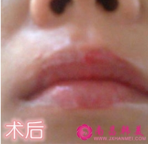 紋唇術后