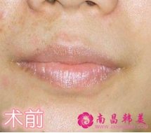 紋唇術前
