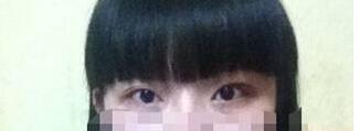 眼瞼下垂矯正術(shù)后