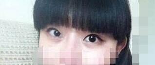 眼瞼下垂矯正案例