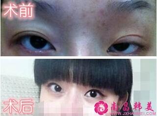眼瞼下垂矯正術(shù)前術(shù)后對(duì)比圖