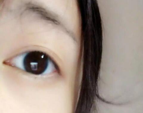 分享下我做的無痕切開雙眼皮