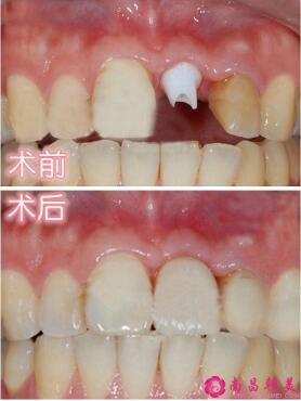 種植牙前后對(duì)比圖