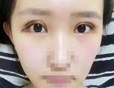 做了雙眼皮，變仙女了
