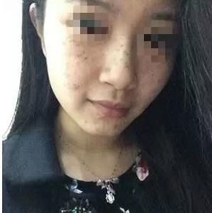 和遺傳的雀斑說拜拜了 太開心了