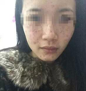和遺傳的雀斑說拜拜了 太開心了