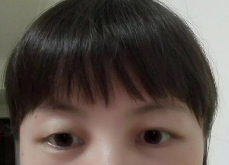 雙眼皮手術(shù)效果就是自然無痕
