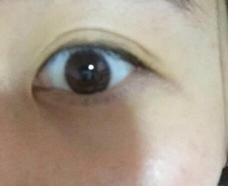 雙眼皮手術(shù)效果就是自然無痕