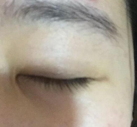 雙眼皮手術(shù)效果就是自然無痕
