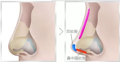 隆鼻手術(shù)之自體耳軟骨的移植