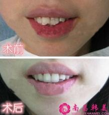 美牙冠術(shù)前術(shù)后對(duì)比圖