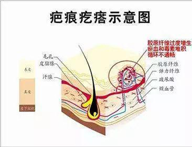 也可以进行激光调节,对疤痕组织造成可控的,有限的损伤,受损皮肤