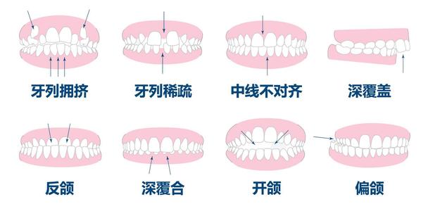 牙齿不齐有哪些危害