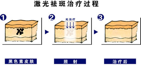 激光祛斑能不能一次性消除