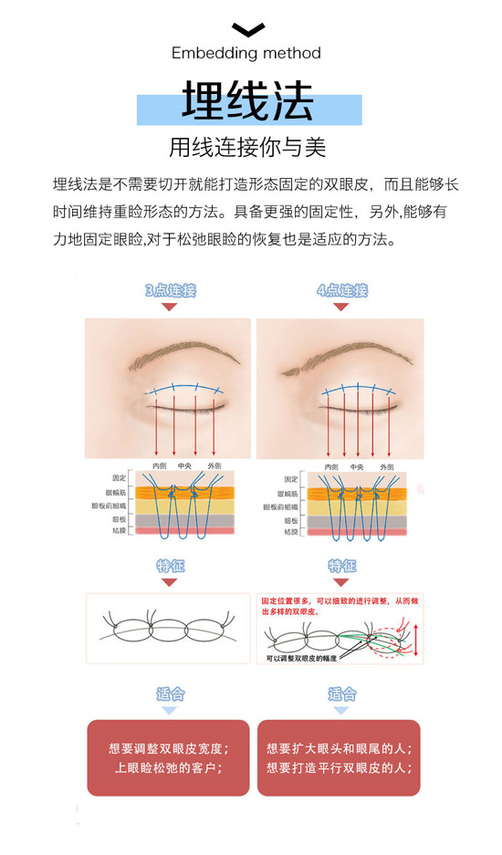 大庆超龙埋线双眼皮 眼部美学形态与个人五官比例相结合 无须切口