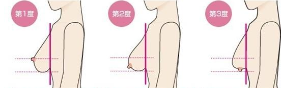 乳房下垂没有女人味 乳房下垂矫正的方法有哪些